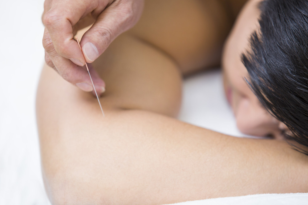 L'acupuncture : une médecine ancestrale aux bienfaits multiples