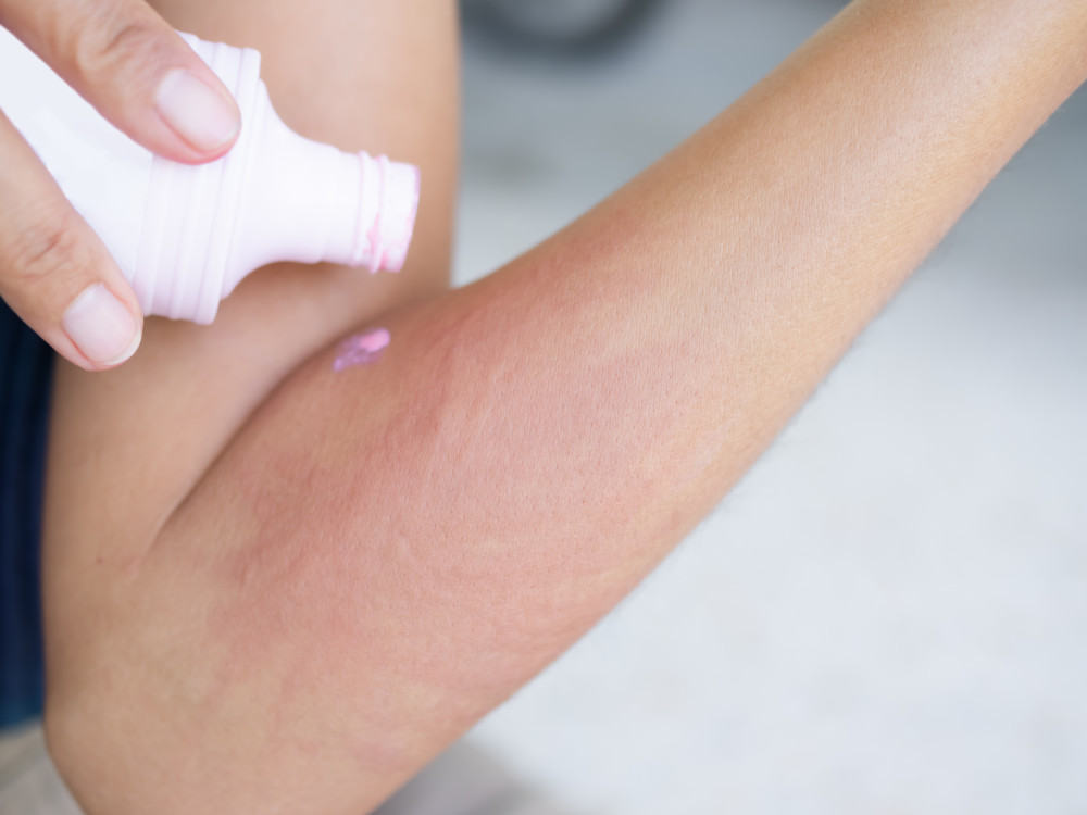 La calamine: comprendre ses causes et ses conséquences